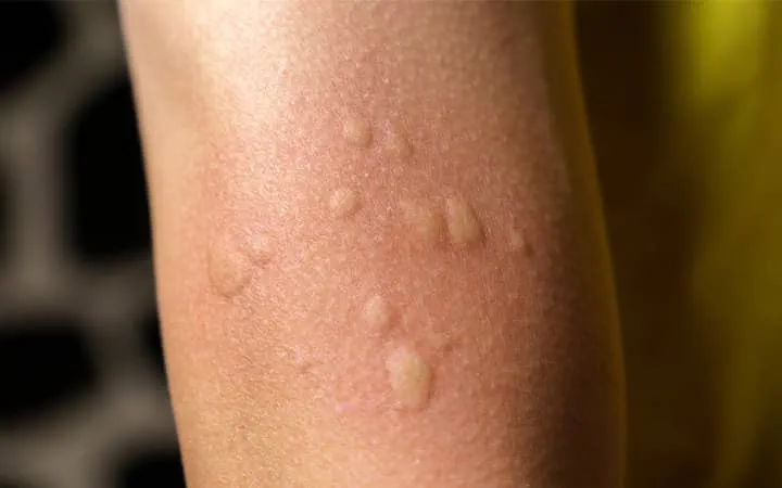 Mosquito bites on skin showing the importance of mosquito control